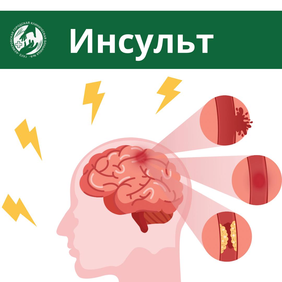 29 октября в России принято считать Днём борьбы с инсультом.